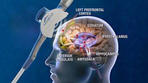 TMS Treatments in Oklahoma, OK